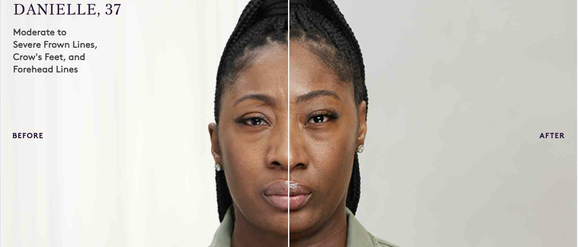 Botox before and after result 2
