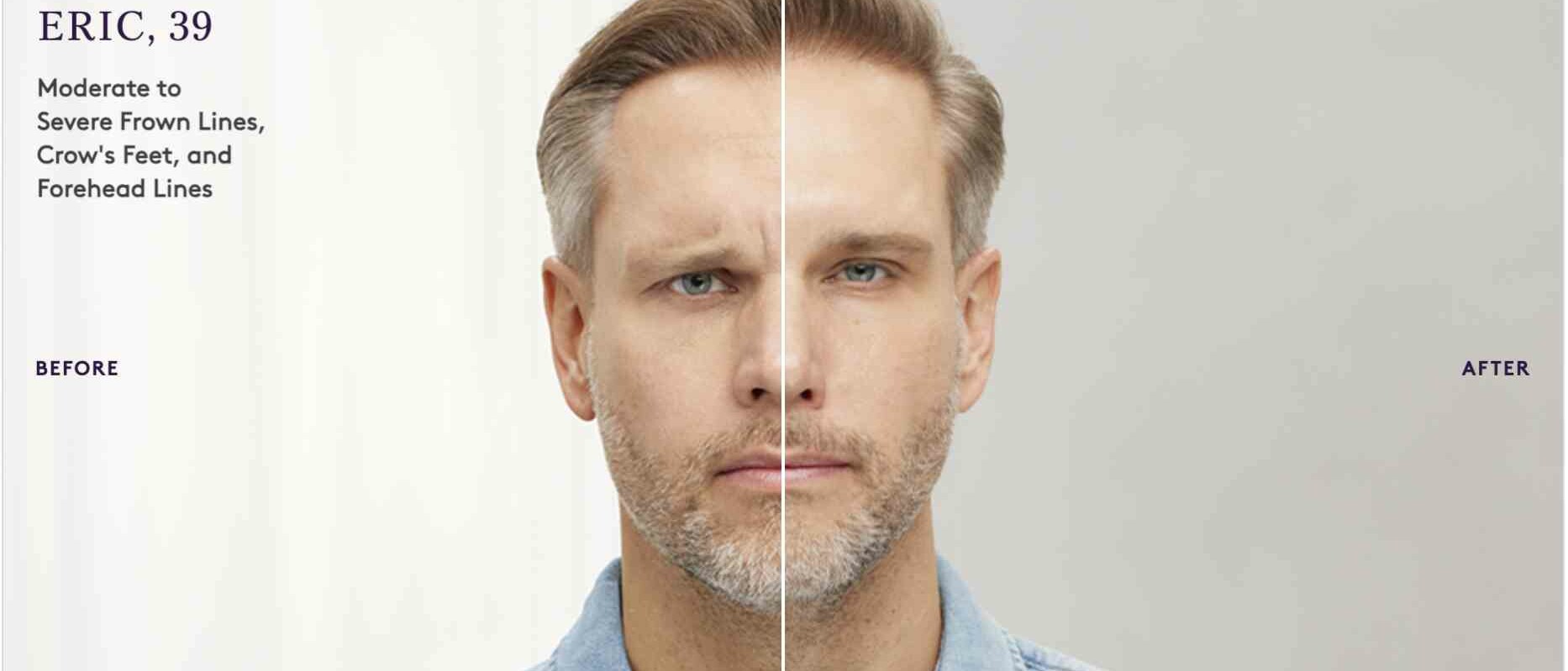 Botox before and after result 3