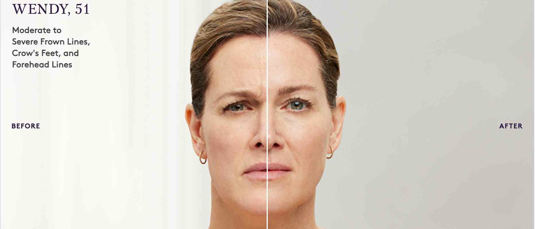 Botox before and after result 4