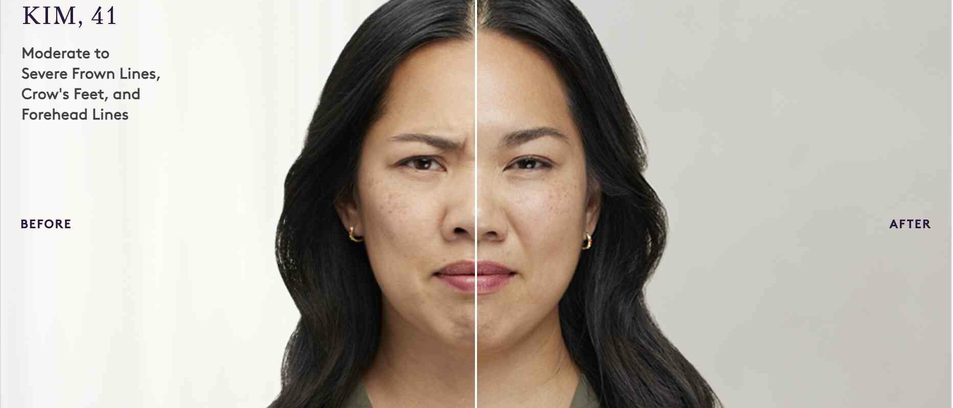 Botox before and after result 5