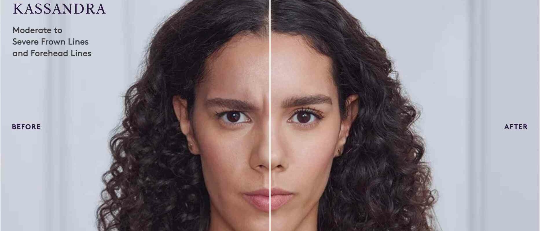 Botox before and after result 6