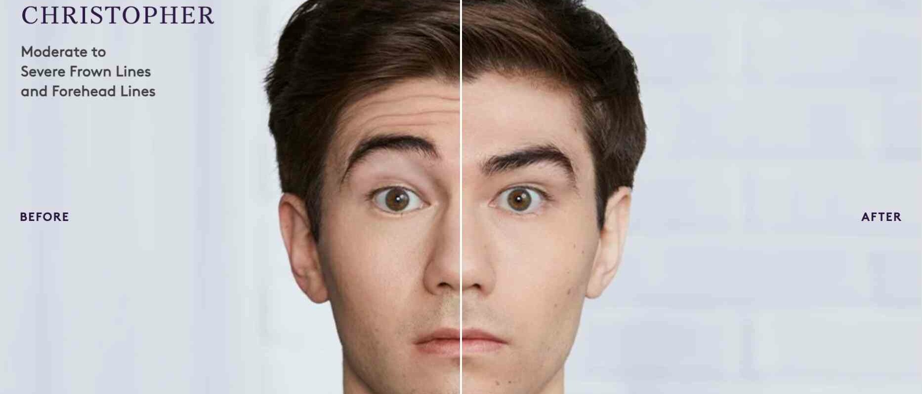 Botox before and after result 7