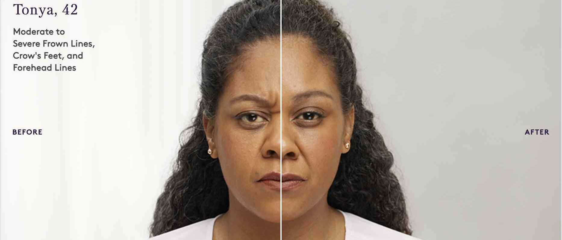 Botox before and after result 1