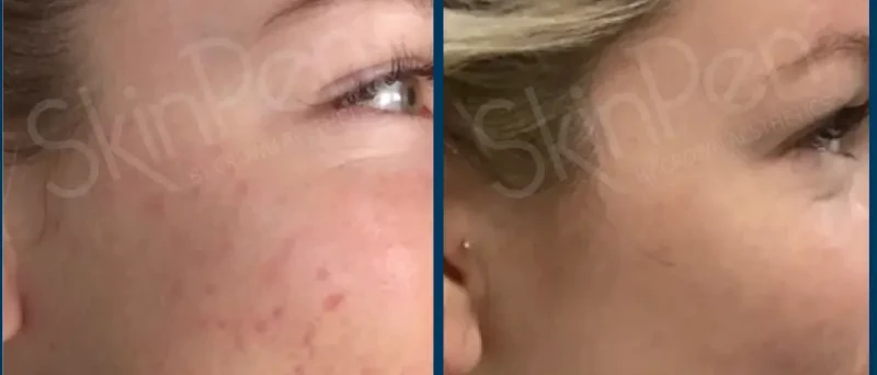 SkinPen microneedling before and after result 6