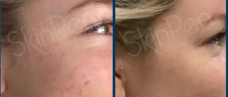 SkinPen microneedling before and after result 4