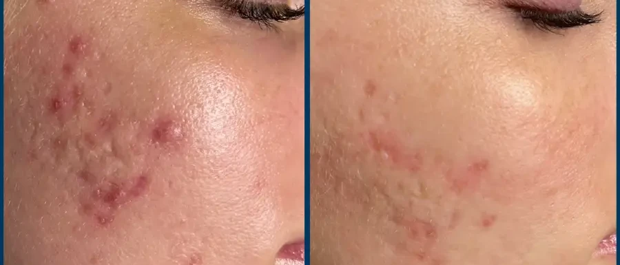 SkinPen microneedling before and after result 3