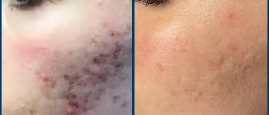 SkinPen microneedling before and after result 2