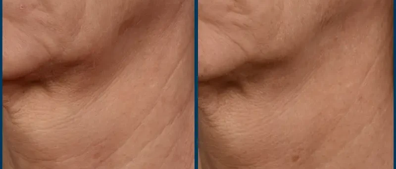 SkinPen microneedling before and after result 1