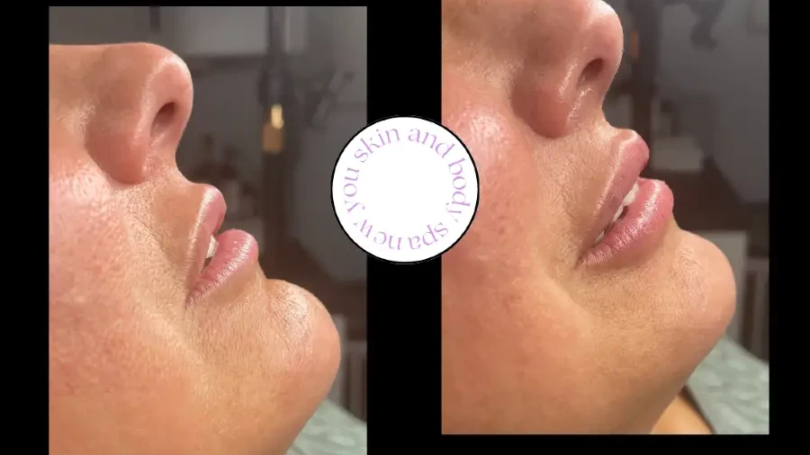 Dermal fillers before and after — patient 1