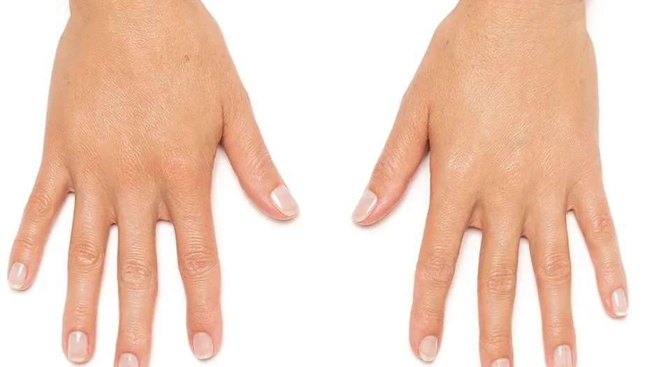 Radiesse after treatment result 2