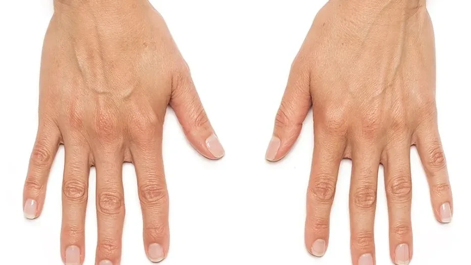 Radiesse before treatment result 2