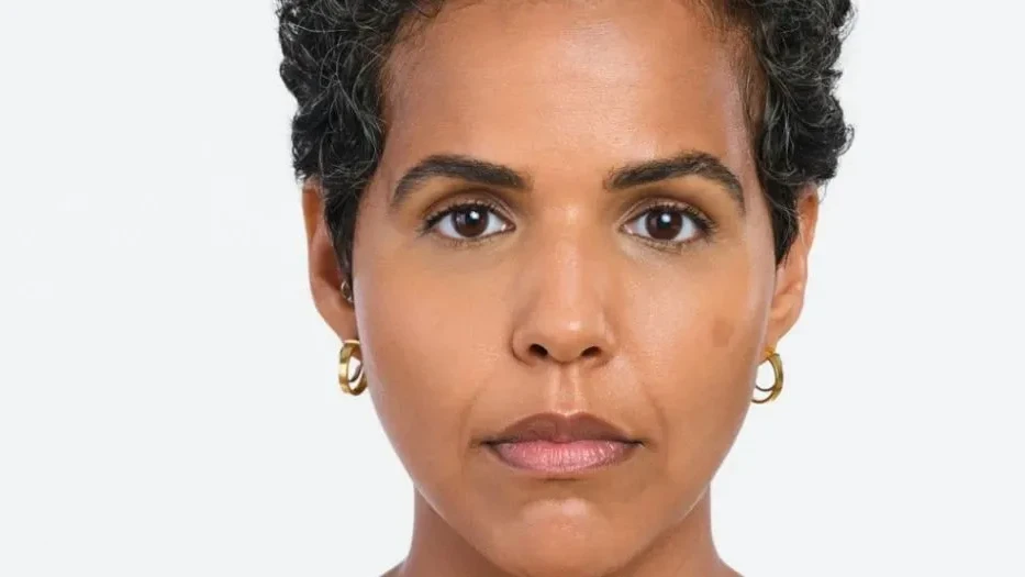 Radiesse before treatment result 3