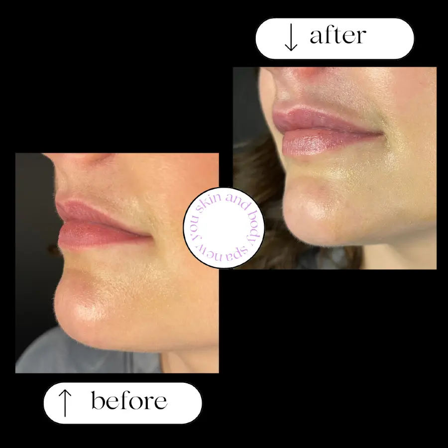 Lip filler before and after — patient 4