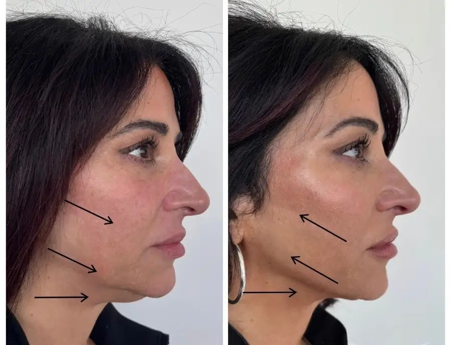 RHA dermal filler before and after — patient 5